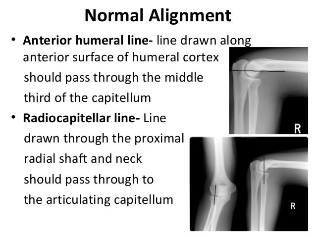 Radiology of the Elbow Joint. Dr. Sumit Sharma
