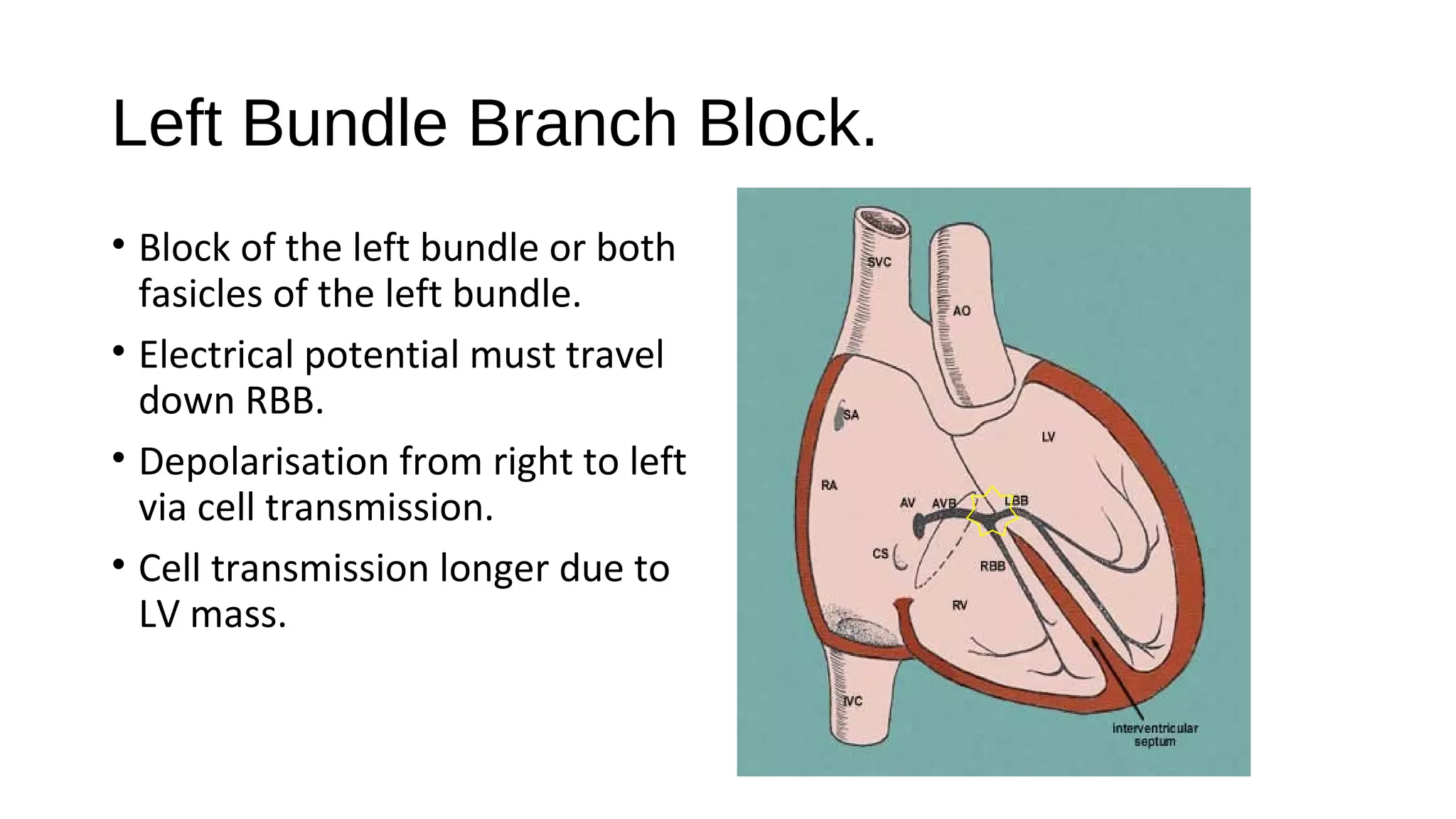Left Bundle Branch Block.
• Block of the left bundle or both
fasicles of the left bundle.
• Electrical potential must travel
down RBB.
• Depolarisation from right to left
via cell transmission.
• Cell transmission longer due to
LV mass.
 