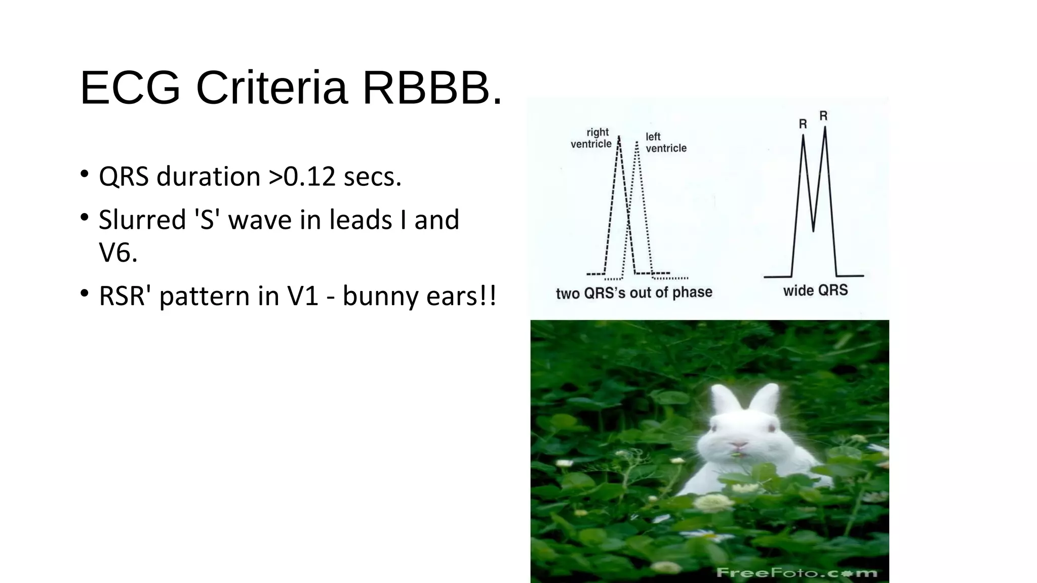 ECG Criteria RBBB.
• QRS duration >0.12 secs.
• Slurred 'S' wave in leads I and
V6.
• RSR' pattern in V1 - bunny ears!!
 