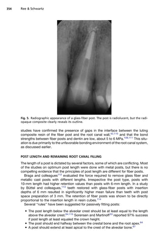 354   Ree  Schwartz




      Fig. 5. Radiographic appearance of a glass-fiber post. The post is radiolucent, but the radi-
      opaque composite clearly reveals its outline.

      studies have confirmed the presence of gaps in the interface between the luting
      composite resin of the fiber post and the root canal wall,42,110 and that the bond
      strengths between fiber posts and dentin are low, about 5 to 6 MPa.109,111 This situ-
      ation is due primarily to the unfavorable bonding environment of the root canal system,
      as discussed earlier.

      POST LENGTH AND REMAINING ROOT CANAL FILLING

      The length of a post is dictated by several factors, some of which are conflicting. Most
      of the studies on optimum post length were done with metal posts, but there is no
      compelling evidence that the principles of post length are different for fiber posts.
        Braga and colleagues112 evaluated the force required to remove glass fiber and
      metallic cast posts with different lengths. Irrespective the post type, posts with
      10-mm length had higher retention values than posts with 6-mm length. In a study
      by Buttel and colleagues,113 teeth restored with glass-fiber posts with insertion
            ¨
      depths of 6 mm resulted in significantly higher mean failure than teeth with post
      space preparation of 3 mm. The retention of fiber posts was shown to be directly
      proportional to the insertion length in resin cubes.114
        Several ‘‘rules’’ have been suggested for passively fitting posts:
          The post length below the alveolar crest should be at least equal to the length
           above the alveolar crest.64,115 Sorensen and Martinoff 53 reported 97% success
           if post length at least equaled the crown height.
          The post should end halfway between the crestal bone and the root apex.64
          A post should extend at least apical to the crest of the alveolar bone.67
 