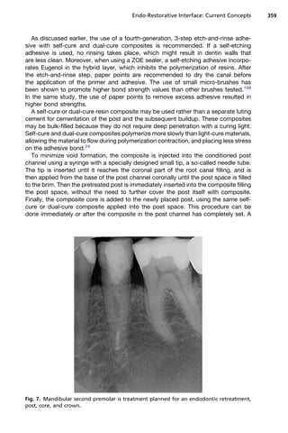 Endo-Restorative Interface: Current Concepts      359



   As discussed earlier, the use of a fourth-generation, 3-step etch-and-rinse adhe-
sive with self-cure and dual-cure composites is recommended. If a self-etching
adhesive is used, no rinsing takes place, which might result in dentin walls that
are less clean. Moreover, when using a ZOE sealer, a self-etching adhesive incorpo-
rates Eugenol in the hybrid layer, which inhibits the polymerization of resins. After
the etch-and-rinse step, paper points are recommended to dry the canal before
the application of the primer and adhesive. The use of small micro-brushes has
been shown to promote higher bond strength values than other brushes tested.159
In the same study, the use of paper points to remove excess adhesive resulted in
higher bond strengths.
   A self-cure or dual-cure resin composite may be used rather than a separate luting
cement for cementation of the post and the subsequent buildup. These composites
may be bulk-filled because they do not require deep penetration with a curing light.
Self-cure and dual-cure composites polymerize more slowly than light-cure materials,
allowing the material to flow during polymerization contraction, and placing less stress
on the adhesive bond.24
   To minimize void formation, the composite is injected into the conditioned post
channel using a syringe with a specially designed small tip, a so-called needle tube.
The tip is inserted until it reaches the coronal part of the root canal filling, and is
then applied from the base of the post channel coronally until the post space is filled
to the brim. Then the pretreated post is immediately inserted into the composite filling
the post space, without the need to further cover the post itself with composite.
Finally, the composite core is added to the newly placed post, using the same self-
cure or dual-cure composite applied into the post space. This procedure can be
done immediately or after the composite in the post channel has completely set. A




Fig. 7. Mandibular second premolar is treatment planned for an endodontic retreatment,
post, core, and crown.
 