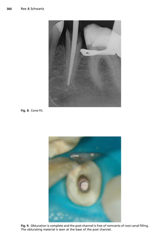 360   Ree  Schwartz




      Fig. 8. Cone-fit.




      Fig. 9. Obturation is complete and the post channel is free of remnants of root canal filling.
      The obturating material is seen at the base of the post channel.
 