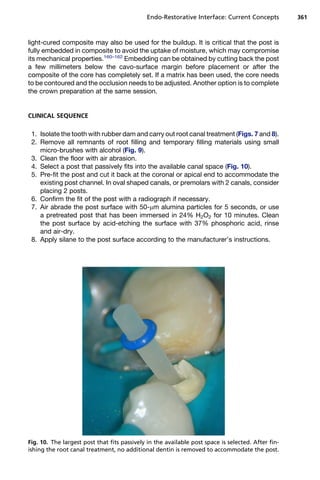 Endo-Restorative Interface: Current Concepts           361



light-cured composite may also be used for the buildup. It is critical that the post is
fully embedded in composite to avoid the uptake of moisture, which may compromise
its mechanical properties.160–162 Embedding can be obtained by cutting back the post
a few millimeters below the cavo-surface margin before placement or after the
composite of the core has completely set. If a matrix has been used, the core needs
to be contoured and the occlusion needs to be adjusted. Another option is to complete
the crown preparation at the same session.


CLINICAL SEQUENCE

 1. Isolate the tooth with rubber dam and carry out root canal treatment (Figs. 7 and 8).
 2. Remove all remnants of root filling and temporary filling materials using small
    micro-brushes with alcohol (Fig. 9).
 3. Clean the floor with air abrasion.
 4. Select a post that passively fits into the available canal space (Fig. 10).
 5. Pre-fit the post and cut it back at the coronal or apical end to accommodate the
    existing post channel. In oval shaped canals, or premolars with 2 canals, consider
    placing 2 posts.
 6. Confirm the fit of the post with a radiograph if necessary.
 7. Air abrade the post surface with 50-mm alumina particles for 5 seconds, or use
    a pretreated post that has been immersed in 24% H2O2 for 10 minutes. Clean
    the post surface by acid-etching the surface with 37% phosphoric acid, rinse
    and air-dry.
 8. Apply silane to the post surface according to the manufacturer’s instructions.




Fig. 10. The largest post that fits passively in the available post space is selected. After fin-
ishing the root canal treatment, no additional dentin is removed to accommodate the post.
 