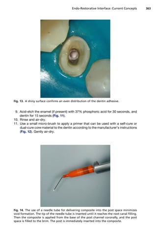 Endo-Restorative Interface: Current Concepts          363




Fig. 13. A shiny surface confirms an even distribution of the dentin adhesive.


 9. Acid-etch the enamel (if present) with 37% phosphoric acid for 30 seconds, and
    dentin for 15 seconds (Fig. 11).
10. Rinse and air-dry.
11. Use a small micro-brush to apply a primer that can be used with a self-cure or
    dual-cure core material to the dentin according to the manufacturer’s instructions
    (Fig. 12). Gently air-dry.




Fig. 14. The use of a needle tube for delivering composite into the post space minimizes
void formation. The tip of the needle tube is inserted until it reaches the root canal filling.
Then the composite is applied from the base of the post channel coronally, and the post
space is filled to the brim. The post is immediately inserted into the composite.
 