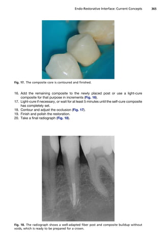 Endo-Restorative Interface: Current Concepts      365




Fig. 17. The composite core is contoured and finished.


16. Add the remaining composite to the newly placed post or use a light-cure
    composite for that purpose in increments (Fig. 16).
17. Light-cure if necessary, or wait for at least 5 minutes until the self-cure composite
    has completely set.
18. Contour and adjust the occlusion (Fig. 17).
19. Finish and polish the restoration.
20. Take a final radiograph (Fig. 18).




Fig. 18. The radiograph shows a well-adapted fiber post and composite buildup without
voids, which is ready to be prepared for a crown.
 