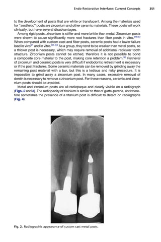 Endo-Restorative Interface: Current Concepts       351



to the development of posts that are white or translucent. Among the materials used
for ‘‘aesthetic’’ posts are zirconium and other ceramic materials. These posts will work
clinically, but have several disadvantages.
   Among rigid posts, zirconium is stiffer and more brittle than metal. Zirconium posts
were shown to cause significantly more root fractures than fiber posts in vitro.89,90
When compared with custom cast and fiber posts, ceramic posts had a lower failure
load in vivo91 and in vitro.92–94 As a group, they tend to be weaker than metal posts, so
a thicker post is necessary, which may require removal of additional radicular tooth
structure. Zirconium posts cannot be etched, therefore it is not possible to bond
a composite core material to the post, making core retention a problem.92 Retrieval
of zirconium and ceramic posts is very difficult if endodontic retreatment is necessary
or if the post fractures. Some ceramic materials can be removed by grinding away the
remaining post material with a bur, but this is a tedious and risky procedure. It is
impossible to grind away a zirconium post. In many cases, excessive removal of
dentin is necessary to remove a zirconium post. For these reasons, ceramic and zirco-
nium posts should be avoided.
   Metal and zirconium posts are all radiopaque and clearly visible on a radiograph
(Figs. 2 and 3). The radiopacity of titanium is similar to that of gutta-percha, and there-
fore sometimes the presence of a titanium post is difficult to detect on radiographs
(Fig. 4).




Fig. 2. Radiographic appearance of custom cast metal posts.
 