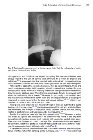 Endo-Restorative Interface: Current Concepts        353




Fig. 4. Radiographic appearance of a titanium post. Note that the radiopacity of gutta-
percha and titanium is very similar.


dislodgements, and 21 failures due to post debonding. The mechanical failures were
always related to the lack of coronal tooth structure. In a review by Dietschi and
colleagues101 it was concluded that nonvital teeth restored with composite resin or
composite resin combined with fiber posts currently represent the best treatment option.
   Although fiber posts offer several advantages, they do have limitations. Posts and
core foundations are subjected to repeated lateral forces in clinical function. Because
nonrigid posts have a modulus of elasticity and flexural strength close to that of dentin,
they flex under occlusal load. When there is an adequate ferrule, the cervical tooth
structure itself resists lateral flexion.95 However, in structurally compromised teeth
that lack cervical stiffness from dentin walls and an adequate ferrule, a flexible post
may result in micro-movement of the core and coronal leakage,102,103 which in turn
may lead to caries or loss of the core and crown.
   Fiber posts were shown to lose flexural strength if they are submitted to cyclic
loading or to thermocycling104,105 due to degradation of the matrix in which the fibers
are embedded. The strength of fiber posts varied between brands, but was directly
related to post diameter and was reduced by thermocycling.106
   Parallel fiber posts are more retentive than tapered posts.107,108 However, in a clin-
ical study by Signore and colleagues99 no difference was found in the long-term
survival rate of maxillary anterior teeth restored with tapered or parallel-sided glass-
fiber posts and full-ceramic crown coverage. The overall survival rate was reported
to be 98.5%. Most fiber posts are relatively radiolucent and have a different radio-
graphic appearance than traditional metal posts (Fig. 5).
   It has been shown that the retention of fiber posts relies mainly on mechanical (fric-
tional) retention rather than bonding, similar to metal posts.41,42,109,110 Several in vitro
 