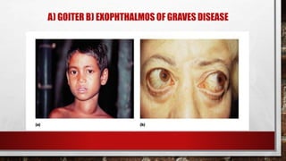 A) GOITER B) EXOPHTHALMOS OF GRAVES DISEASE
 