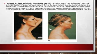 • ADRENOCORTICOTROPIC HORMONE (ACTH) – STIMULATES THE ADRENAL CORTEX
TO SECRETE MINERALOCORTICOIDS, GLUCOCORTICOIDS, OR GONADOCORTICOIDS.
[HYPERSECRETION CAUSES CUSHING’S DISEASE, WHILE HYPOSECRETION IS RARE].
 