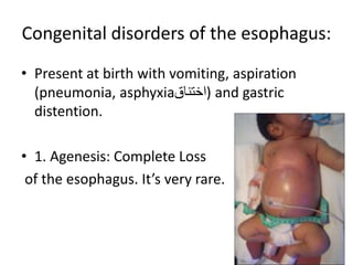 Congenital disorders of the esophagus:
• Present at birth with vomiting, aspiration
(pneumonia, asphyxia‫)اختناق‬ and gastric
distention.
• 1. Agenesis: Complete Loss
of the esophagus. It’s very rare.
 
