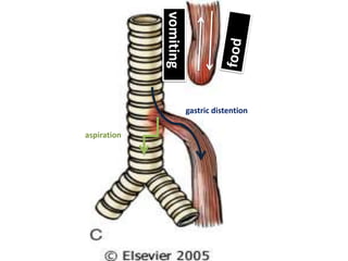 vomiting
gastric distention
aspiration
 