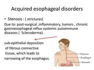 Acquired esophageal disorders
• Stenosis : ( strictures)
Due to: post-surgical ,inflammatory, tumors , chronic
gastroesophageal reflux systemic autoimmune
diseases ( Scleroderma) .
sub‐epithelial deposition
of fibrous connective
tissue, which leads to
narrowing of the esophagus.
 
