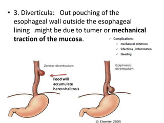 • 3. Diverticula: Out pouching of the
esophageal wall outside the esophageal
lining .might be due to tumer or mechanical
traction of the mucosa.
Food will
accumulate
here>>halitosis
 