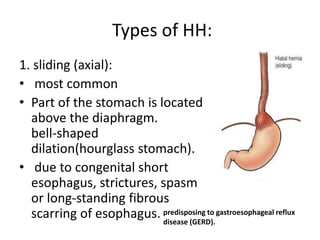 Types of HH:
1. sliding (axial):
• most common
• Part of the stomach is located
above the diaphragm.
bell‐shaped
dilation(hourglass stomach).
• due to congenital short
esophagus, strictures, spasm
or long‐standing fibrous
scarring of esophagus. predisposing to gastroesophageal reflux
disease (GERD).
 