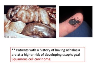 ** Patients with a history of having achalasia
are at a higher risk of developing esophageal
Squamous cell carcinoma.
 
