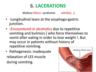 6. LACERATIONS
Mallory‐Weiss syndrome whiskey ;)
• ‐Longitudinal tears at the esophago‐gastric
junction.
• ‐Encountered in alcoholics due to repetitive
vomiting and bulimics [ who force themselves to
vomit after eating in order to lose weight !. But
may occur in patients without history of
repetitive vomiting.
• Pathogenesis: inadequate
relaxation of LES muscle
during vomiting.
 