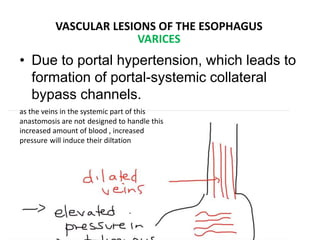 • Due to portal hypertension, which leads to
formation of portal-systemic collateral
bypass channels.
VASCULAR LESIONS OF THE ESOPHAGUS
VARICES
as the veins in the systemic part of this
anastomosis are not designed to handle this
increased amount of blood , increased
pressure will induce their diltation
 