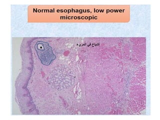 ‫المريء‬ ‫في‬ ‫أشباح‬
 