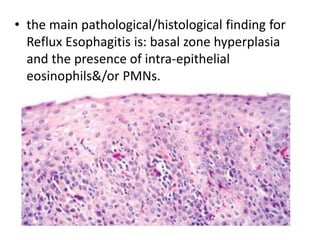 • the main pathological/histological finding for
Reflux Esophagitis is: basal zone hyperplasia
and the presence of intra-epithelial
eosinophils&/or PMNs.
 
