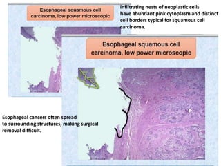 Esophageal cancers often spread
to surrounding structures, making surgical
removal difficult.
infiltrating nests of neoplastic cells
have abundant pink cytoplasm and distinct
cell borders typical for squamous cell
carcinoma.
 