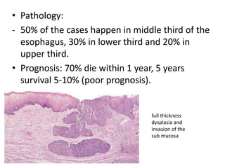 • Pathology:
- 50% of the cases happen in middle third of the
esophagus, 30% in lower third and 20% in
upper third.
• Prognosis: 70% die within 1 year, 5 years
survival 5-10% (poor prognosis).
full thickness
dysplasia and
invasion of the
sub mucosa
 