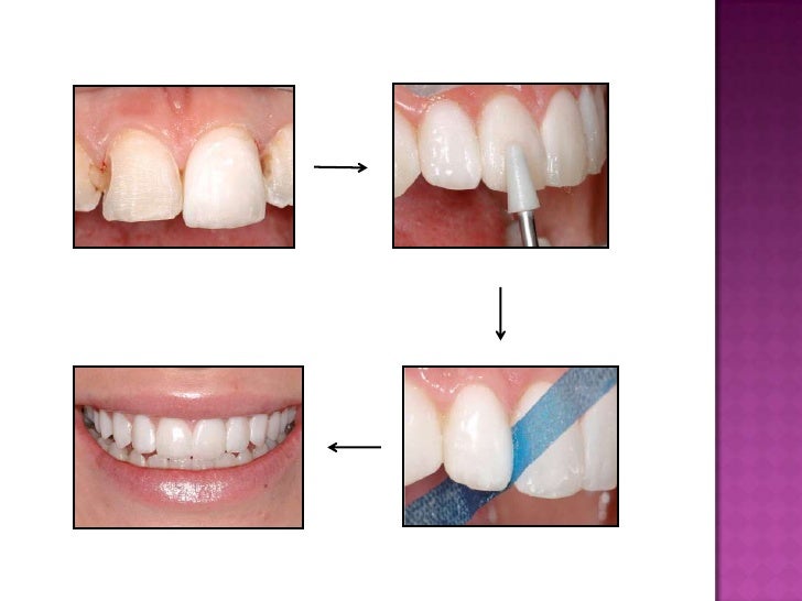 Dental Veneers