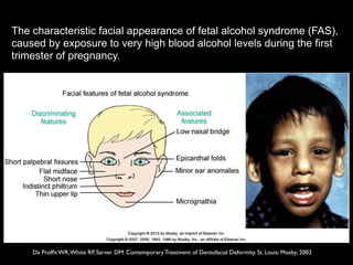 The characteristic facial appearance of fetal alcohol syndrome (FAS),
caused by exposure to very high blood alcohol levels during the first
trimester of pregnancy.
Da Profﬁt WR,White RP, Sarver DM. Contemporary Treatment of Dentofacial Deformity. St. Louis: Mosby; 2003
 