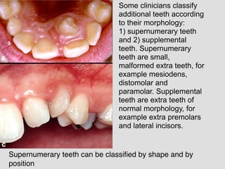 Some clinicians classify
additional teeth according
to their morphology:
1) supernumerary teeth
and 2) supplemental
teeth. Supernumerary
teeth are small,
malformed extra teeth, for
example mesiodens,
distomolar and
paramolar. Supplemental
teeth are extra teeth of
normal morphology, for
example extra premolars
and lateral incisors.
Supernumerary teeth can be classiﬁed by shape and by
position
 