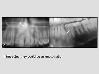 If impacted they could be asymptomatic
 
