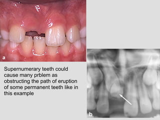 Supernumerary teeth could
cause many prblem as
obstructing the path of eruption
of some permanent teeth like in
this example
 