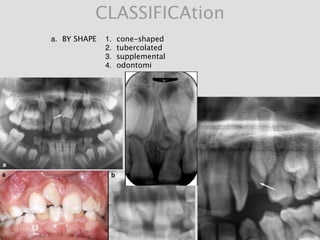 CLASSIFICAtion
a. BY SHAPE 1. cone-shaped
2. tubercolated
3. supplemental
4. odontomi
 