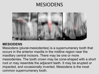 MESIODENS
MESIODENS
Mesiodens (plural-mesiodentes) is a supernumerary tooth that
occurs in the anterior maxilla in the midline region near the
maxillary central incisors. There may be one or more
mesiodentes. The tooth crown may be cone-shaped with a short
root or may resemble the adjacent teeth. It may be erupted or
impacted, and occasionally inverted. Mesiodens is the most
common supernumerary tooth.
 