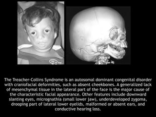 The Treacher-Collins Syndrome is an autosomal dominant congenital disorder
with craniofacial deformities, such as absent cheekbones. A generalized lack
of mesenchymal tissue in the lateral part of the face is the major cause of
the characteristic facial appearance. Other features include downward
slanting eyes, micrognathia (small lower jaw), underdeveloped zygoma,
drooping part of lateral lower eyelids, malformed or absent ears, and
conductive hearing loss.
 