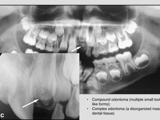 • Compound odontoma (multiple small toot
like forms);!
• Complex odontoma (a disorganized mass
dental tissue)
 