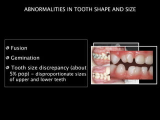 Fusion
Gemination
Tooth size discrepancy (about
5% pop) - disproportionate sizes
of upper and lower teeth
ABNORMALITIES IN TOOTH SHAPE AND SIZE
 