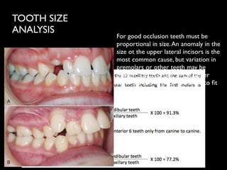 TOOTH SIZE
ANALYSIS
For good occlusion teeth must be
proportional in size.An anomaly in the
size ot the upper lateral incisors is the
most common cause, but variation in
premolars or other teeth may be
present. Occasionally, all the upper
teeth are too large or too small to ﬁt
properly with the lower teeth
 