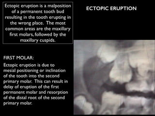 Ectopic eruption is a malposition
of a permanent tooth bud
resulting in the tooth erupting in
the wrong place.  The most
common areas are the maxillary
ﬁrst molars, followed by the
maxillary cuspids.
ECTOPIC ERUPTION
FIRST MOLAR:	

Ectopic eruption is due to
mesial positioning or inclination
of the tooth into the second
primary molar.  This can result in
delay of eruption of the ﬁrst
permanent molar and resorption
of the distal root of the second
primary molar. 
 