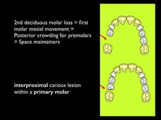 2nd deciduous molar loss = ﬁrst
molar mesial movement =
Posterior crowding for premolars
= Space maintainers
interproximal carious lesion
within a primary molar
 