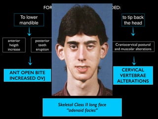FOR MOUTH BREATHING IS NEEDED:
Skeletal Class II long face
“adenoid facies”
To lower
mandible
to lower
tongue
to tip back
the head
Lingual pressure on maxilla
decreases and buccinators
muscle pressure increases
anterior
heigth
increase
posterior
teeth
eruption
Craniocervical postural
and muscolar alterations
MAXILLA
CONTRACTION
CROSS BITE
ANT OPEN BITE
INCREASED OVJ
CERVICAL
VERTEBRAE
ALTERATIONS
 