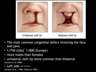 • The most common congenital defect involving the face
and jaws
• 1/750 (USA) 1/800 (Europe)
• more males than females
• unilateral cleft lip more common than bilateral
(Jensen et al.1988)
• Left side ++++++
(Jensen et al., 1988; Tolarova 1987)
 