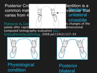 Posterior Crossbite in the mixed dentition is a
common malocclusion, with a prevalence that
varies from 4% to 23%
Phatouros A, Goonewardene MS Morphologic changes of the
palate after rapid maxillary expansion: a 3-dimensional
computed tomography evaluation Am J
OrthodDentofacialOrthop. 2008 Jul;134(1):117-24
Physiological
condition
Posterior
bilateral
Posterior
unilateral
crossbite
 