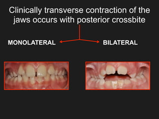 Clinically transverse contraction of the
jaws occurs with posterior crossbite
MONOLATERAL BILATERAL
 