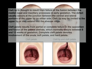 Cleft lip is thought to result from failure of the fusion between the
medial nasal and maxillary processes in early gestation. The defect
usually occurs at the junction between the central and lateral
portions of the upper lip on either side. Cleft lip may be limited to the
upper lip or may extend into the alveolar ridge.!
!
Cleft palate results from partial or complete failure in the apposition
and fusion of the palatal shelves, which normally occurs between 8
and 12 weeks of gestation. Complete cleft palate denotes
involvement of the uvula, soft palate, and hard palate. !
!
 