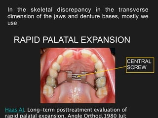 In the skeletal discrepancy in the transverse
dimension of the jaws and denture bases, mostly we
use
RAPID PALATAL EXPANSION
Haas AJ. Long-term posttreatment evaluation of
rapid palatal expansion. Angle Orthod.1980 Jul;
CENTRAL
SCREW
 