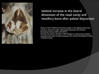 skeletal increase in the lateral
dimension of the nasal cavity and
maxillary bone after palatal disjunction
Chung C, Font B. Skeletal and dental changes in the sagittal, vertical and
transverse dimensions after rapid palatal expansion.Am J Orthod
Dentofacial Orthop. 2004;126:569-75.
Hershey HG, Stewart BL,Warren DW. Changes in nasal airway resistance	

associated with rapid maxillary expansion.Am J Orthod Dentofacial Orthop.	

1976;69:274-84.
 