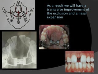 As a result,we will have a
transverse improvement of
the occlusion and a nasal
expansion
 