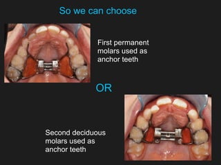 So we can choose
OR
First permanent
molars used as
anchor teeth
Second deciduous
molars used as
anchor teeth
 