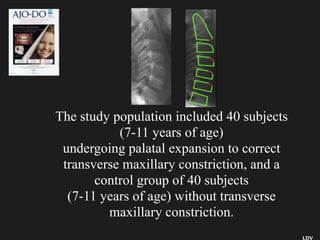 LDV
The study population included 40 subjects
(7-11 years of age)
undergoing palatal expansion to correct
transverse maxillary constriction, and a
control group of 40 subjects
(7-11 years of age) without transverse
maxillary constriction.
 