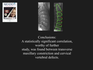 Conclusions:
A statistically significant correlation,
worthy of further
study, was found between transverse
maxillary constriction and cervical
vertebral defects.
 