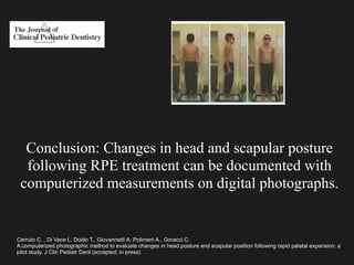 Cerruto C. , Di Vece L, Doldo T., Giovannetti A, Polimeni A., Goracci C.
A computerized photographic method to evaluate changes in head posture and scapular position following rapid palatal expansion: a
pilot study. J Clin Pediatr Dent (accepted; in press)
Conclusion: Changes in head and scapular posture
following RPE treatment can be documented with
computerized measurements on digital photographs.
 